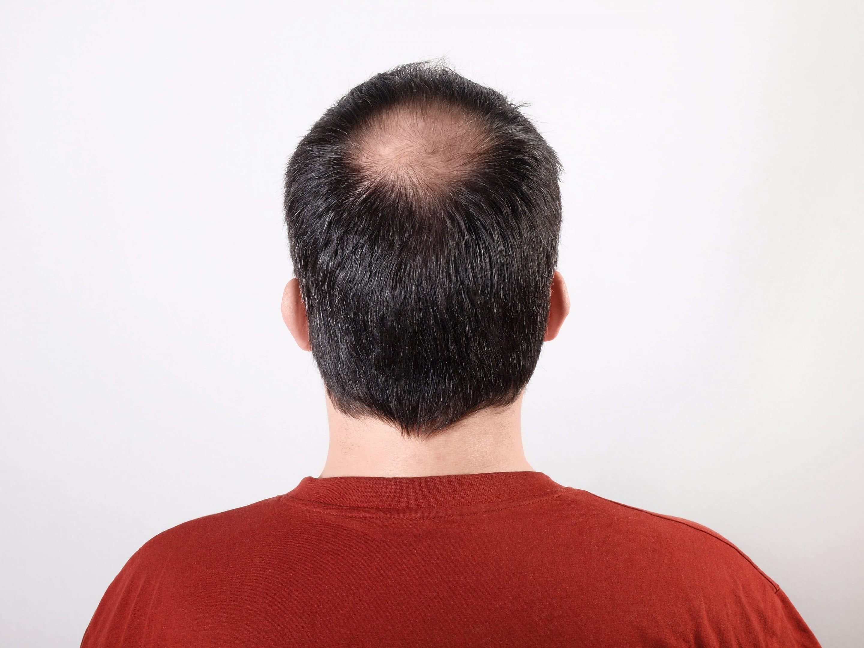 Die Fakten enthüllt: Wie viele Haare hat ein Mensch auf dem Körper?